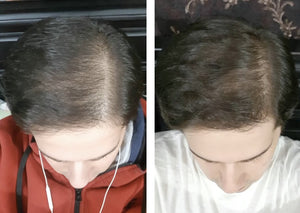 results-of-using-rosemary-oil-for-hair-growth.jpg